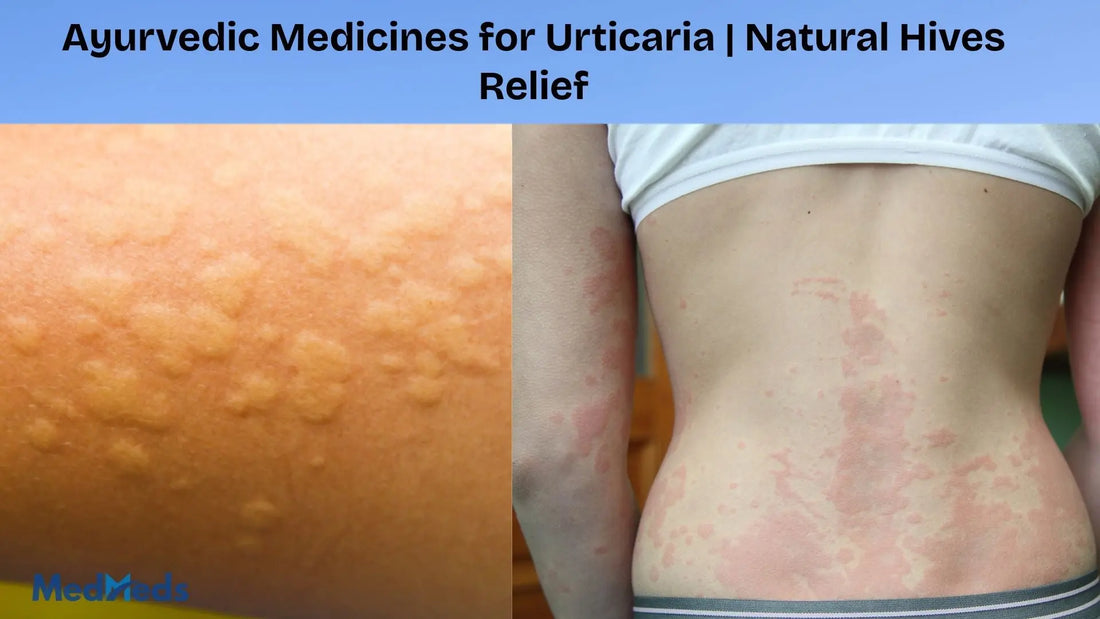 Ayurvedic Medicines for Urticaria