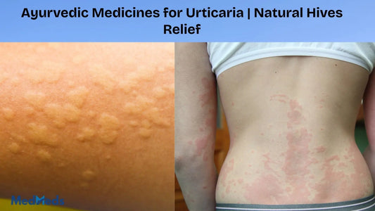 Ayurvedic Medicines for Urticaria