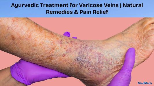Varicose Veins